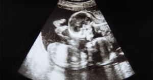 Seeing Double: The Medical Facts About Twin Pregnancies